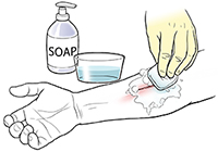 Gloved hand cleaning wound on forearm with soap and water.