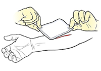 Gloved hands placing bandage on wound on forearm.