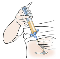 Hand pressing plunger on syringe filled with liquid food attached to feeding tube port.