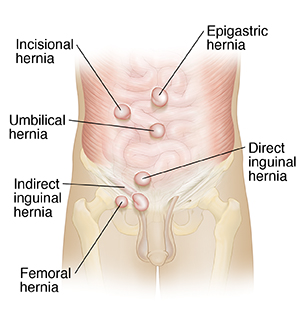 Front view of male abdomen showing types of hernias.