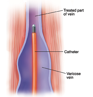 Cross section of muscle and vein showing ablation catheter in vein.