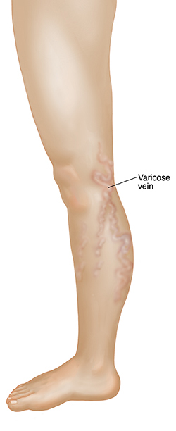 Side view of leg showing varicose veins.