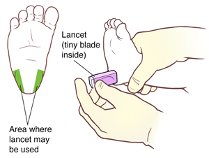 Bottom view of infant's foot showing areas for heelstick on heel. Green shows area on sole to use. Gloved hands holding lancet against infant's heel.