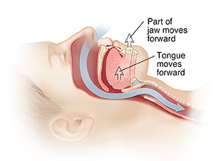 Side view of head with arrow showing path of air through nasal passages into trachea. Arrows show jaw moved forward after surgery.