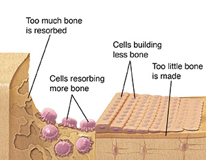 Bone with osteoporosis showing osteoblasts not making enough bone and osteoclasts resorbing too much.