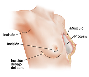 Vista tres cuartos de un pecho femenino mostrando las incisiones de un implante de seno a la derecha y una sección cruzada de de un seno izquierdo mostrando un implante colocado en su lugar.