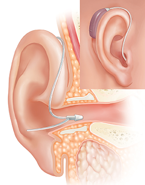 Corte transversal de un oído, donde pueden verse las estructuras del oído externo, interno y medio, con un audífono que lleva el receptor colocado en el oído y un recuadro que muestra la vista externa.