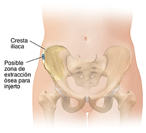 Vista frontal de la parte inferior del abdomen femenino donde se muestran los huesos pélvicos. El área en azul muestra la posible zona donante de tejido óseo para injerto.