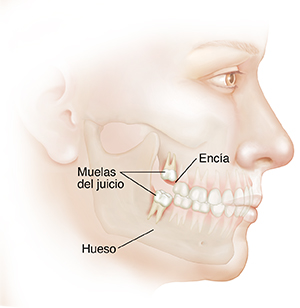 Vista lateral de la cara de un adulto donde se observan los dientes de los maxilares superior e inferior. Las muelas del juicio atraviesan las encías y tienen las raíces arraigadas al hueso.