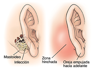 Vista lateral de un oído en la que se ve la infección en la apófisis mastoides. Vista lateral de una oreja en la que se ve una zona hinchada detrás de la oreja, de modo que la empuja hacia adelante.