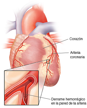Vista frontal ampliada del corazón donde se observa una disección en la arteria coronaria.