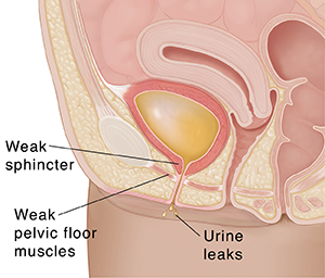 Closeup cross section of female pelvis showing stress incontinence.