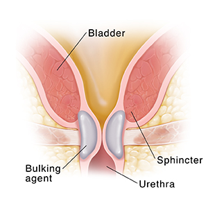 Closeup cross section of bladder neck showing bulking agent holding bladder neck closed.