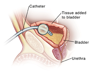 Side view of cross section of child's pelvis showing bladder and urethra. Catheter inserted through skin above pubic bone is draining urine from bladder.