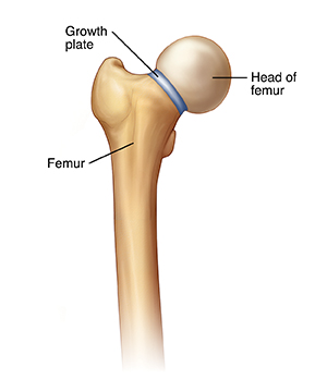 Front view of femur showing growth plate between neck of femur and femoral head.