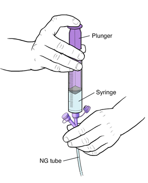 Closeup of hand NG tube with syringe inserted in port. Other hand is pressing down plunger on syringe.