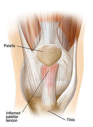 Front view of knee joint showing patella, tibia, and inflamed patellar tendon.