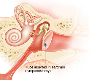 Cross section of child's ear showing fluid in middle ear and inflamed eustachian tube. Tube is in eardrum.