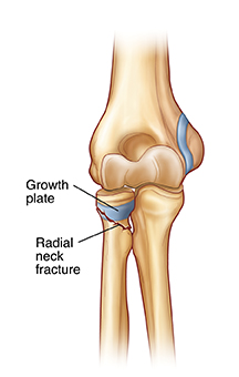 Vista frontal de la articulación del codo que muestra fractura del cuello del radio.