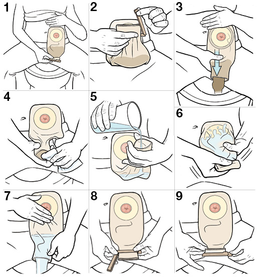 9 pasos para vaciar la bolsa del estoma.